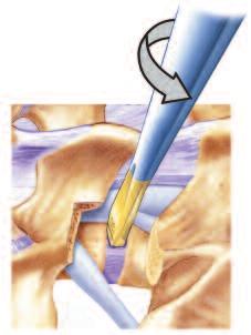 A Starter Dilator is inserted horizontally into a collapsed disc space and then rotated 90 degrees to