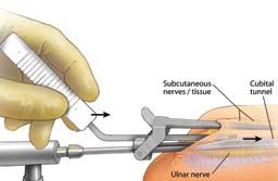 8-1 8-2 Step 8 Incision of the Fascia - Distally Insert the Blade into the slot on the Cannula (Figure 8-1). Use the endoscope to visualize the fascia and the Blade.