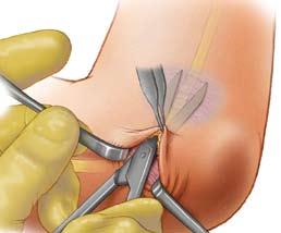 2-1 2-2 2-3 Step 2 Expose Cubital Tunnel Use scissors to elevate the subcutaneous tissue and create space between the deep fascia and the