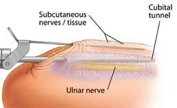 Under no circumstances should the fascia be divided unless the ulnar nerve is clearly visualized through the slots below the Cannula.