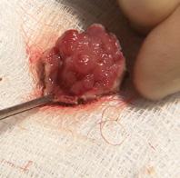 Following markings, begin resection by incising to perirectal fat on distal side of lesion.