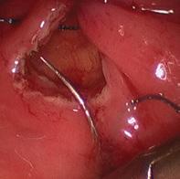 requiring suture closure of the peritoneum and rectal wall.