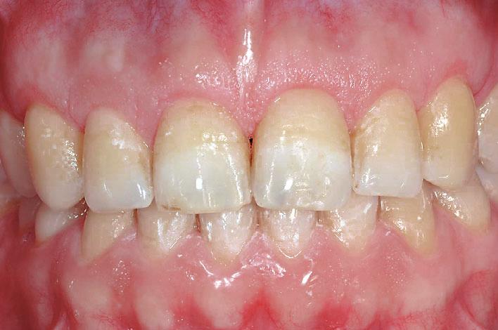 ROSSI ET AL Publication Abstract Excessive gingival display, frequently seen in adults and resulting in short clinical crowns, has been described in the literature several authors as altered passive