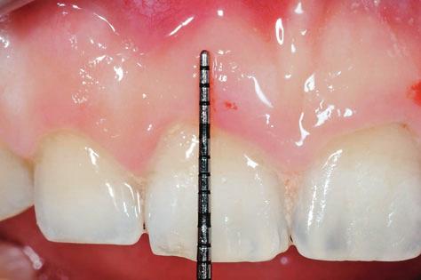 The treatment plan was to remove the excessive soft tissue to expose the teeth fully to