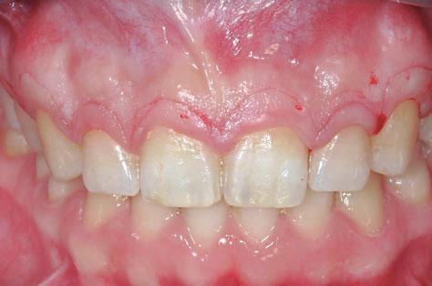 least 2 mm. In some areas, one-third of the clinical crowns were covered with gingiva.
