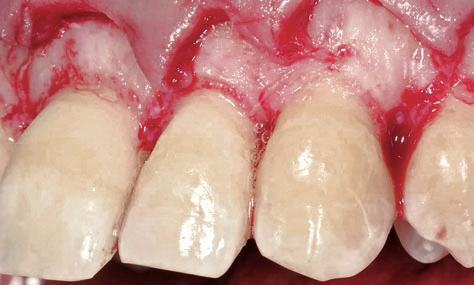Soft tissues were removed and the true lengths of the clinical crowns were exposed (Fig 14).