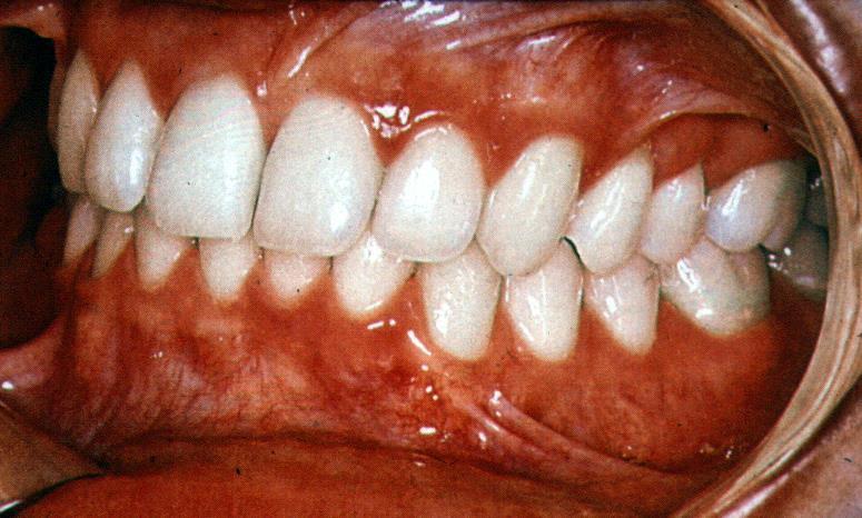 Diphydont dentition Permanent