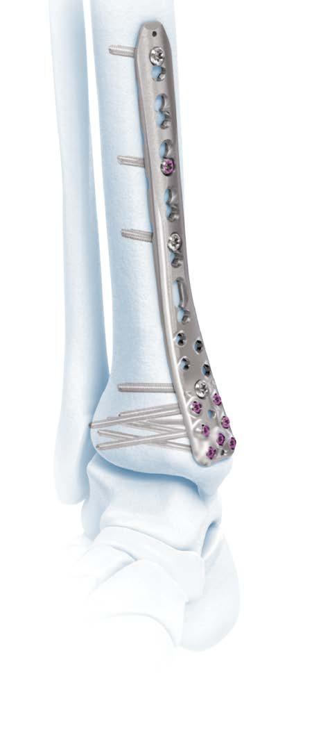 2.7 mm/ 3.5 mm Variable Angle LCP Technology Plates Distal Tibia Plates The head of the distal tibia plates features multiple variable angle locking holes that accept 2.7 mm VA locking, 2.