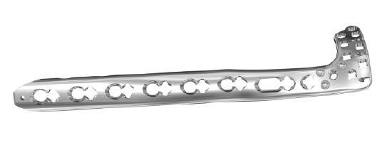 7 mm locking screw (at nominal angle) 3.5 mm variable angle locking screw 3.