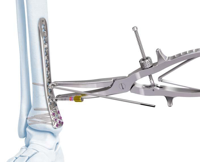 Compression and Distraction System Compression and Distraction Forceps Provide tactile compression or