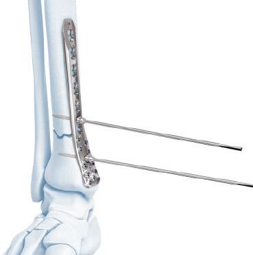 Compression and Distraction System Technique: Compressing or Distracting a Fracture or Osteotomy A second fixation point on the bone segment opposite the fracture or osteotomy is required and can be