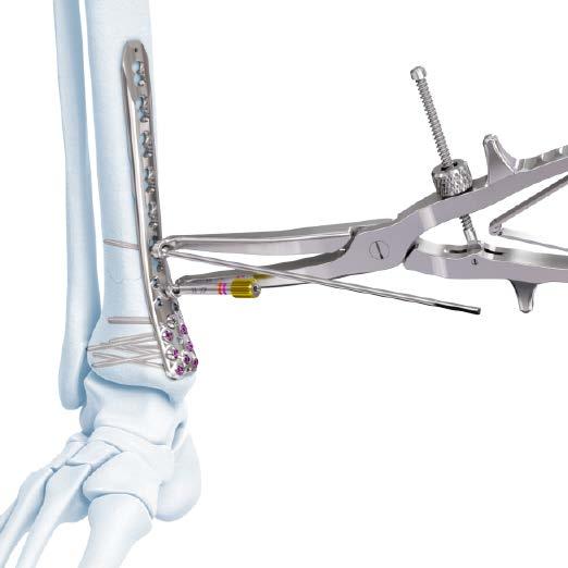 Compression and Distraction System Technique: Compressing or Distracting a Fracture or Osteotomy 2. Compress or distract Instruments 03.118.