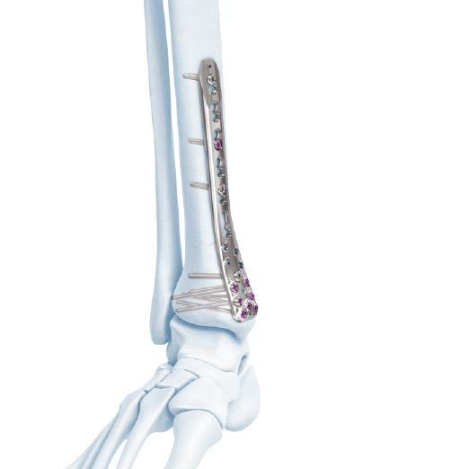 2.7 mm/ 3.5 mm VA Locking Medial and Anteromedial Distal Tibia Plate Technique Lock Variable Angle Screws Confirm Reduction and Fixation 7.