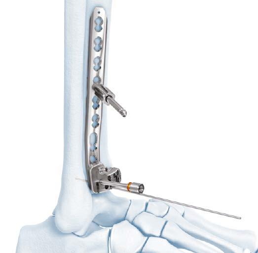 2.7 mm/ 3.5 mm VA Locking Anterolateral Distal Tibia Plate Technique Position Plate and Fix Provisionally 3. Position plate and fix provisionally Optional instruments 03.118.