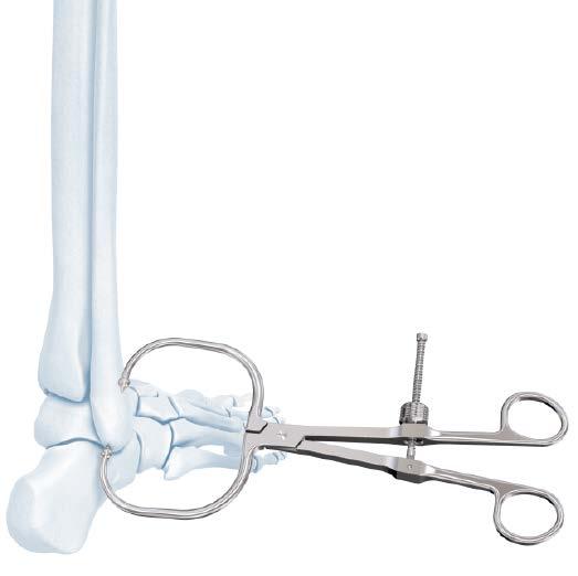 2.7 mm VA Locking Lateral Distal Fibula Plate Technique Reduce Fracture 1. Reduce fracture Instruments 03.118.001 Periarticular Reduction Forceps, small 03.118.110 Periarticular Reduction Forceps, medium 394.