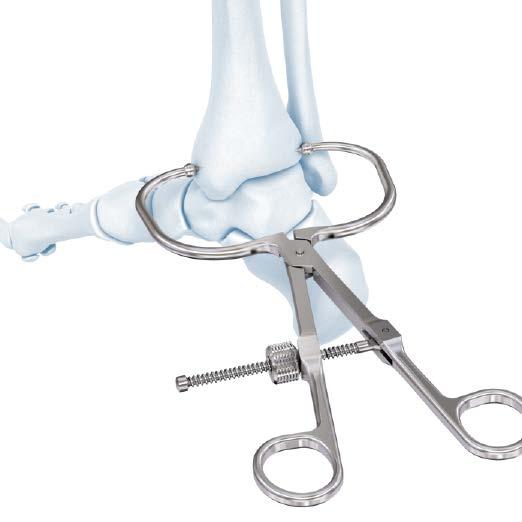 2.7 mm VA Locking Distal Tibia T- and L- Plate Technique Reduce Articular Surface 1. Reduce articular surface Instruments 03.118.001 Periarticular Reduction Forceps, small 03.118.110 Periarticular Reduction Forceps, medium 394.
