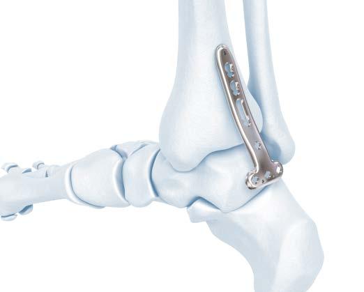 2.7 mm VA Locking Distal Tibia T- and L- Plate Technique Reduce Articular Surface Insert Plate 2.