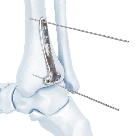 2.7 mm VA Locking Distal Tibia T- and L- Plate Technique Position Plate and Fix Provisionally 3. Position plate and fix provisionally Optional instruments 03.118.