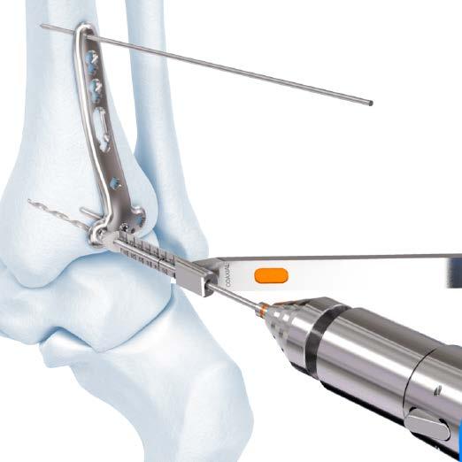 2.7 mm VA Locking Distal Tibia T- and L- Plate Technique Insert Distal Screws 5. Insert distal screws Instruments For 2.7 mm variable angle locking screws 03.118.007 Percutaneous Depth Gauge for 2.
