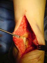 tenodesis screw Repair or
