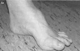 What is a Cavus Foot?