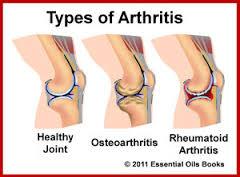 Types of Arthritis Degenerative Arthritis Osteoarthritis is the most common type of arthritis. When cartilage wears away, bone rubs against bone, causing pain, swelling and stiffness.
