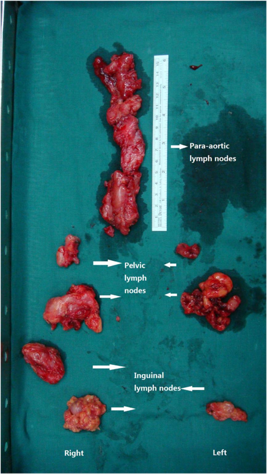 Liu et al. World Journal of Surgical Oncology 2014, 12:51 bladder excision, hysterectomy, bilateral adnexectomy, omentectomy and lymph node excision.