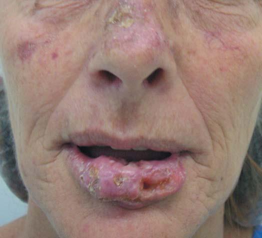 196 Conti LA, Carvalho MM, Machado Filho CDS, Hayashida ME, Ferraz TS, Gonçalves Jr. BF or Zplastia for defects affecting less than one-third of the lip.