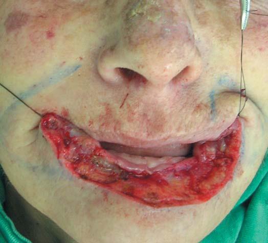 The patient presented with nodular-ulcerative infiltrative lesions, which at the time of the first visit affected one-third of the lower lip.