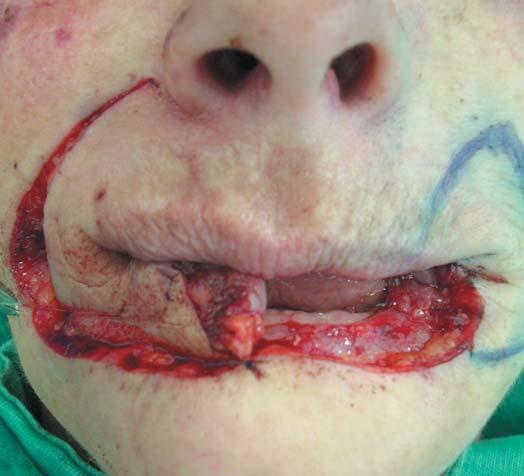 Lip reconstruction 197 Figure 4: Right side Karapandzic flap Figure 6: Appearance in the immediate post-operative period Figure 5: Left side Gilles flap and their location), combined with adjuvant