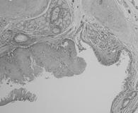 cell hyperplasia (DIPNECH) Squamous metaplasia, dysplasia and
