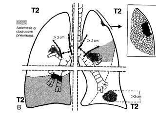 Lung Cancer Staging Small Cell Carcinoma Limited- confined to hemithorax Extensive Non-small Cell Carcinoma T, N, M Clinical Stage 1-4 100 90 80 70 60 50 40 30 20 10 0 International Staging