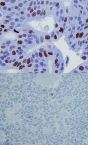 Immunohistochemical markers are important for verifying the NET; synaptophysin and Well-differentiated neurendocrine tumor by H&E staining Chromogranin are standard.