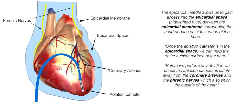 Epicardial Access for VT ablation Epicardial