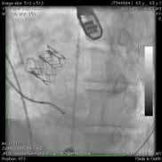 Leaflet Morphology Bisucpid vs Tricuspid 68yo man 10 years post heart Tx