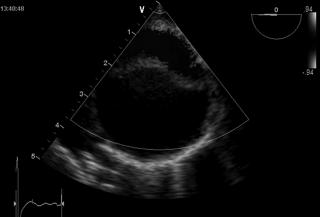 medio-lateral plane Aortic