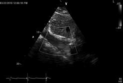 as flow is away from transducer Aortic flow