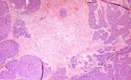 A definition of triple-negative breast cancer Immunohistochemistry ER PR HER2 ER and