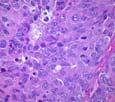 staining or 2+ staining with negative FISH Histologic subtypes that are often TNBC