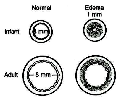 Airway Resistance Full Term Newborn Airway 1mm of edema, the diameter will be 44% of normal.