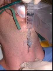 Needle Cricothyrotomy A quick fix, buys some