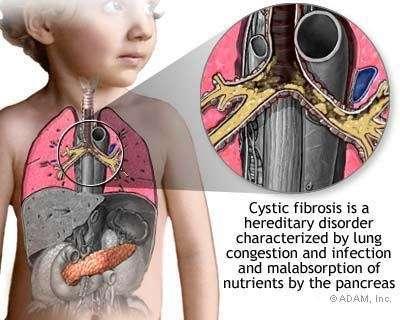 Special Populations Cystic Fibrosis