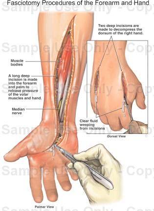Compartment syndrome most commonly results from crush injury of the hand rare causes include