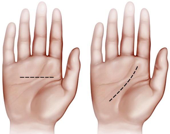 hypothenar space drain palmar and dorsal, incise longitudinally or transversely