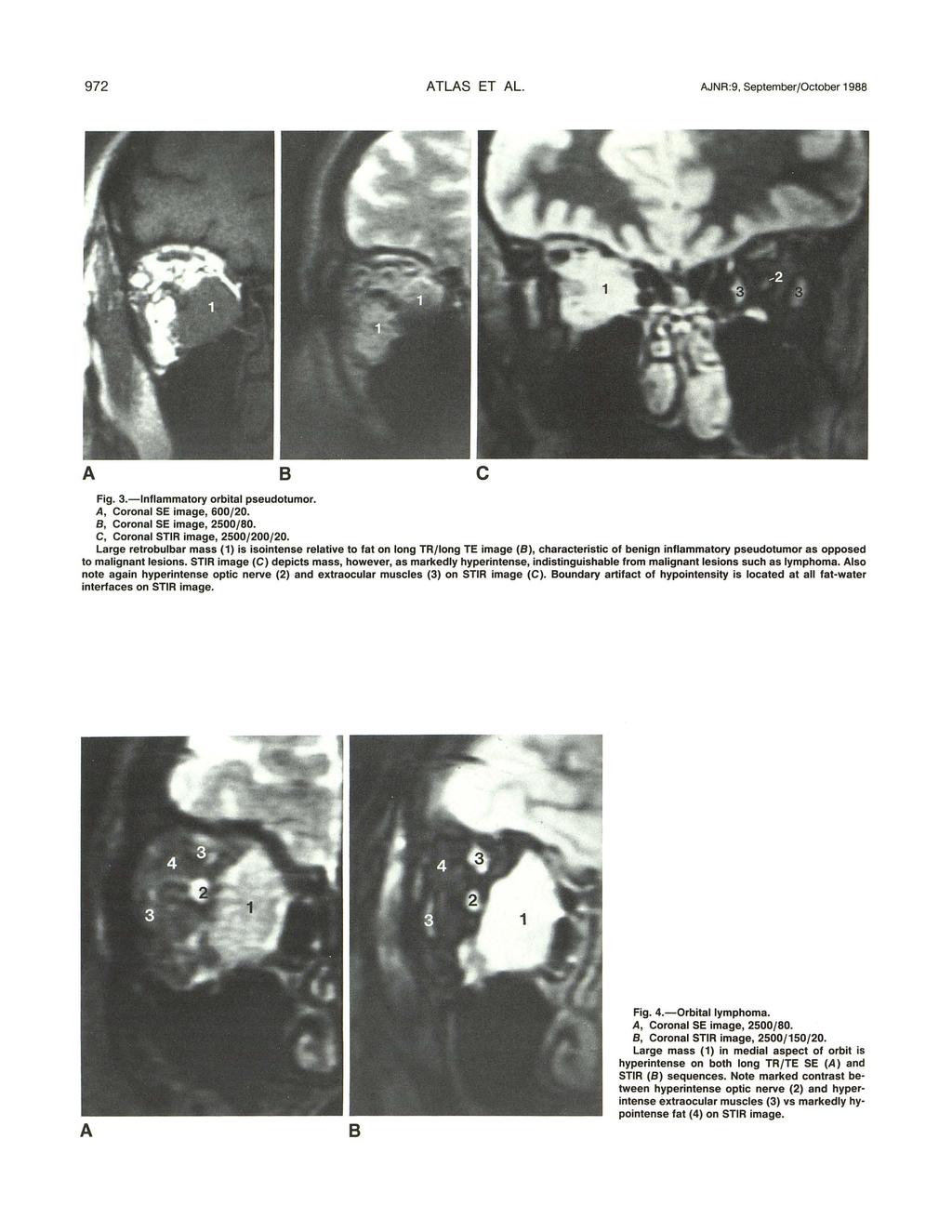 972 TLS ET L. JNR:9, September/Otober 1988 Fig. 3.-lnflammatory orbital pseudotumor., Coronal SE image, 600/20. 8, Coronal SE image, 2500/80. C, Coronal STIR image, 2500/200/20.