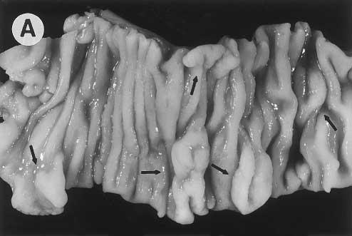 750 TORLAKOVIC AND SNOVER GASTROENTEROLOGY Vol. 110, No. 3 it was difficult to precisely compare it with polyps in our patients due to more complex architecture.