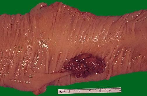 Age: 60 to 65 years, Present with rectal bleeding or anemia, large
