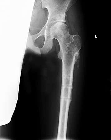 Observations: 5 Weeks David s surgical wound was healed and while he was still using crutches his gait was good. X-rays revealed that his left femoral head had not collapsed but was healed.