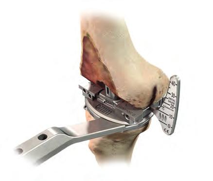 Conventional Cut Guides allow for assessing the anterior