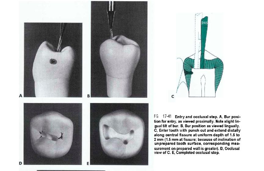 resistance form (occlusal step)is provided by: (1) the pulpal wall being relatively flat and smooth and perpendicular to forces directed with the long axis of the tooth (2) providing enough thickness